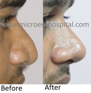 Rhinoplasty Costs In Different Locations Rhinoplasty Costs In Different Locations