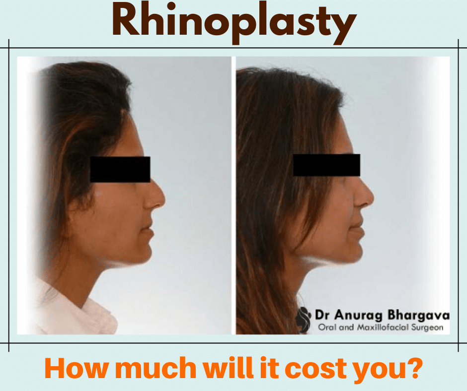 Rhinoplasty Costs In Different Locations Rhinoplasty Costs In Different Locations