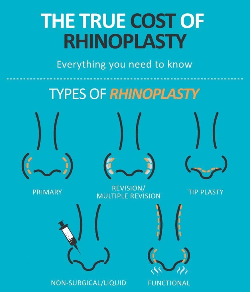 Rhinoplasty Costs In Different Locations Rhinoplasty Costs In Different Locations