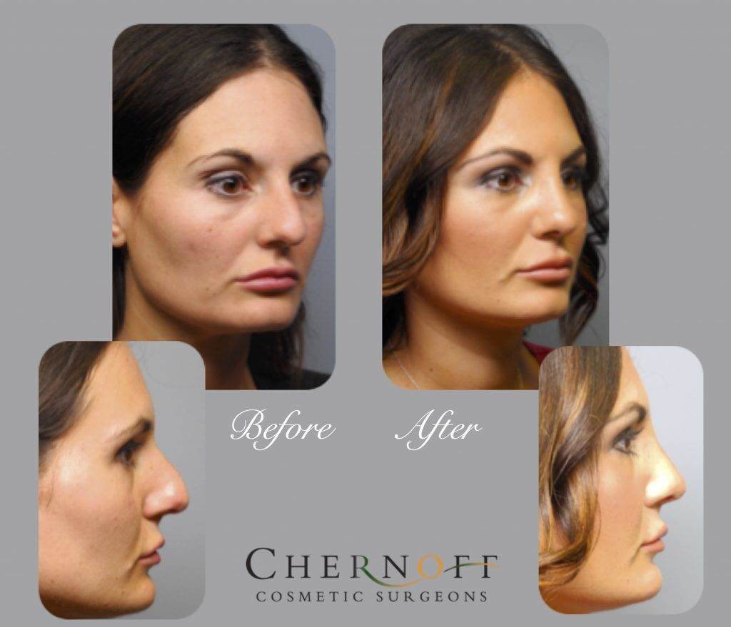 Rhinoplasty Costs Indianapolis Indiana Rhinoplasty Costs Indianapolis Indiana