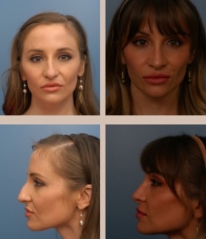 Rhinoplasty Costs Indianapolis Indiana Rhinoplasty Costs Indianapolis Indiana