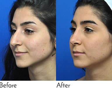 Rhinoplasty Costs Jacksonville Florida