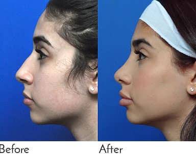 Rhinoplasty Costs Jacksonville Florida