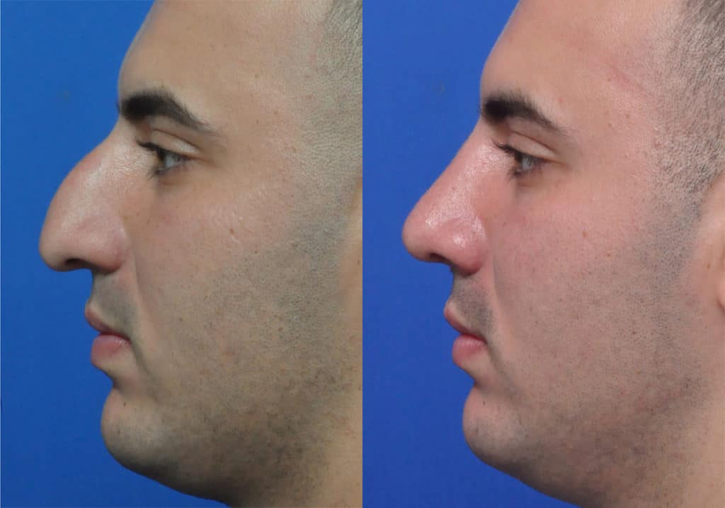 Rhinoplasty Costs Jacksonville Florida