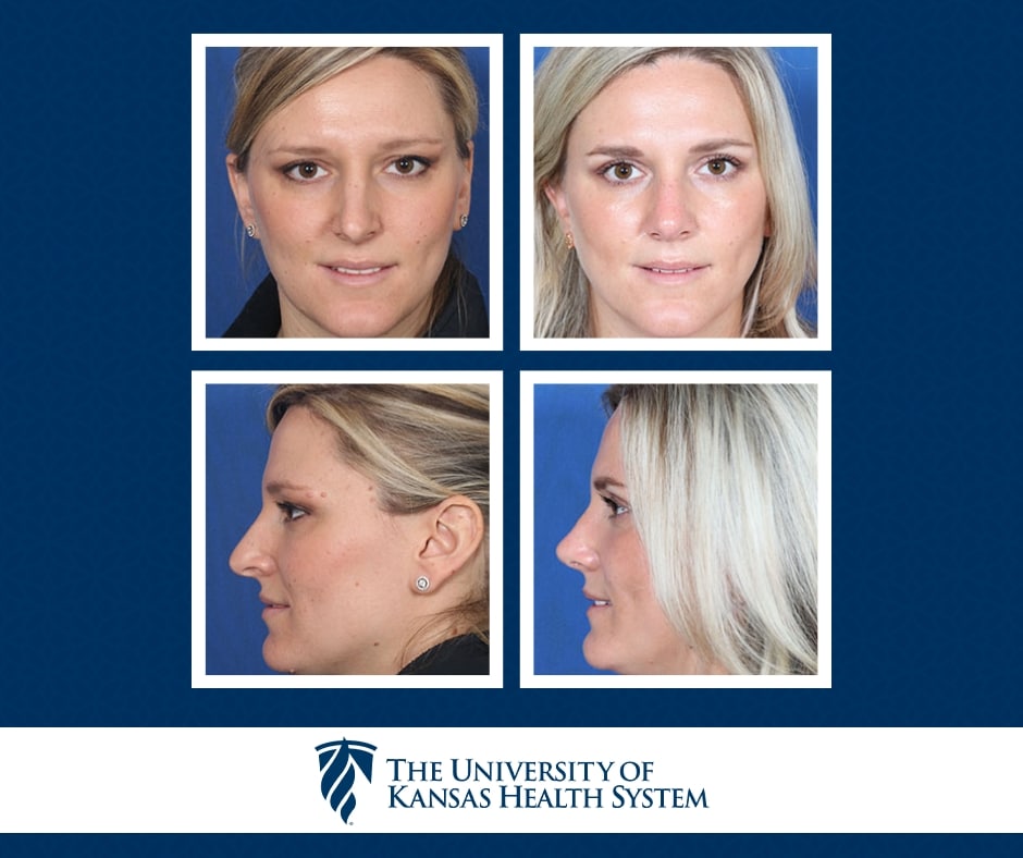 Rhinoplasty Costs Kansas City Missouri