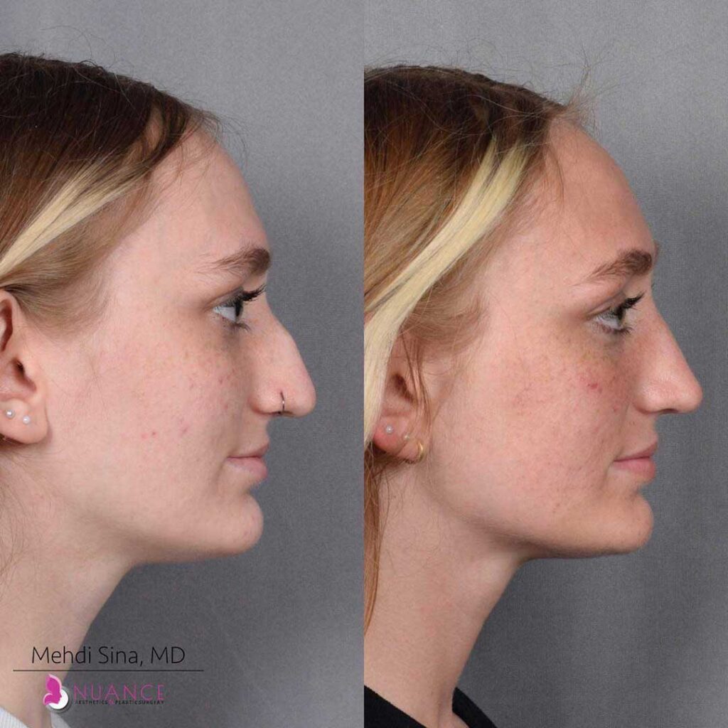 Rhinoplasty Costs Las Vegas Nevada