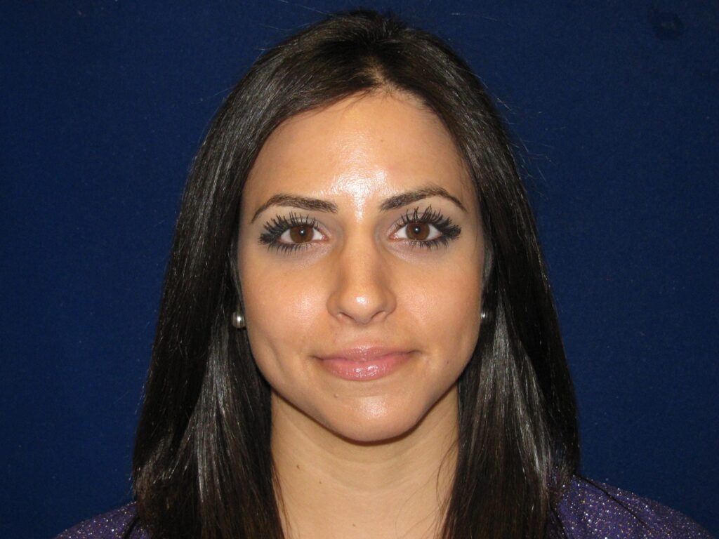 Rhinoplasty Costs Las Vegas Nevada
