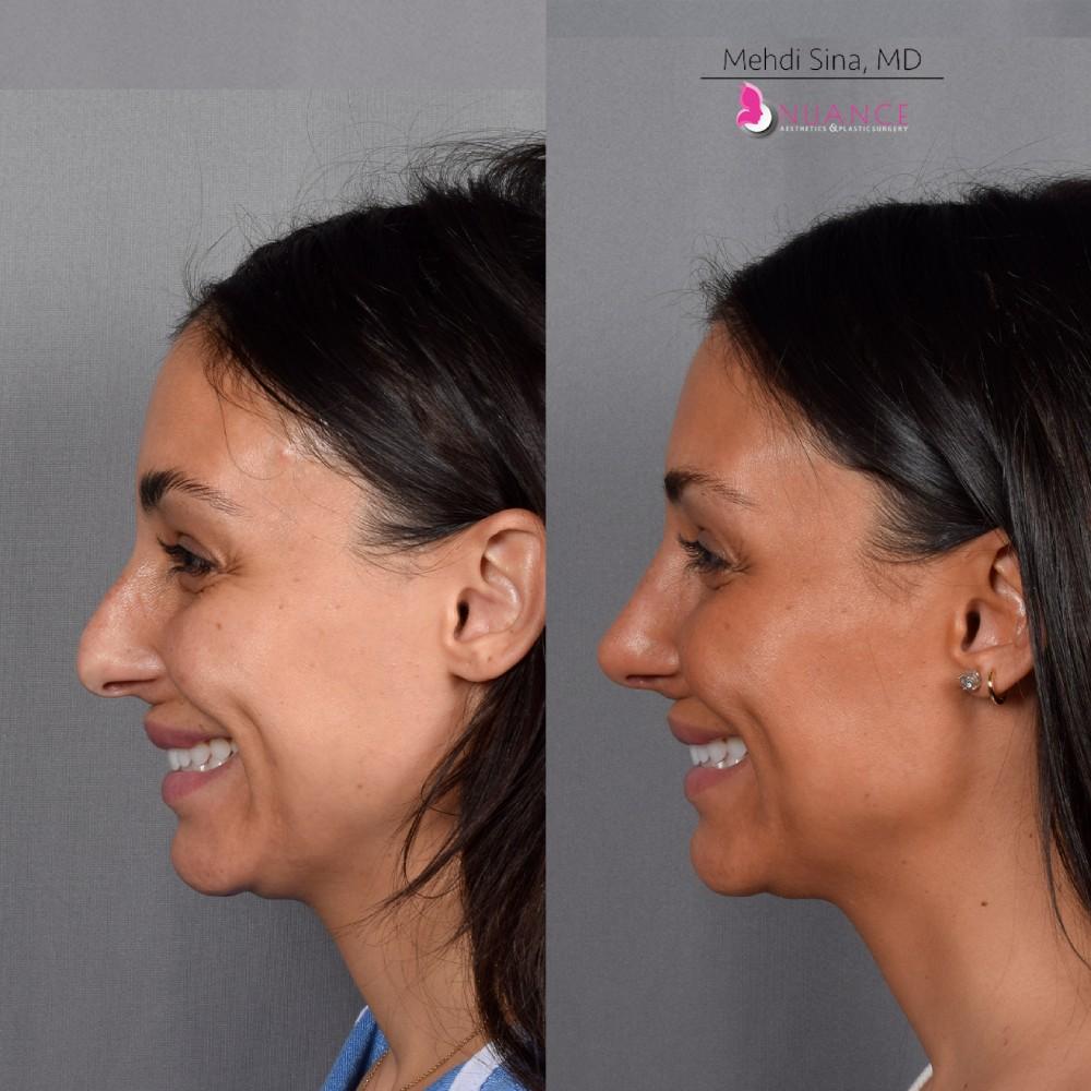Rhinoplasty Costs Las Vegas Nevada