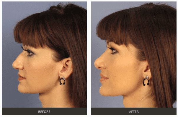 Rhinoplasty Costs Las Vegas Nevada
