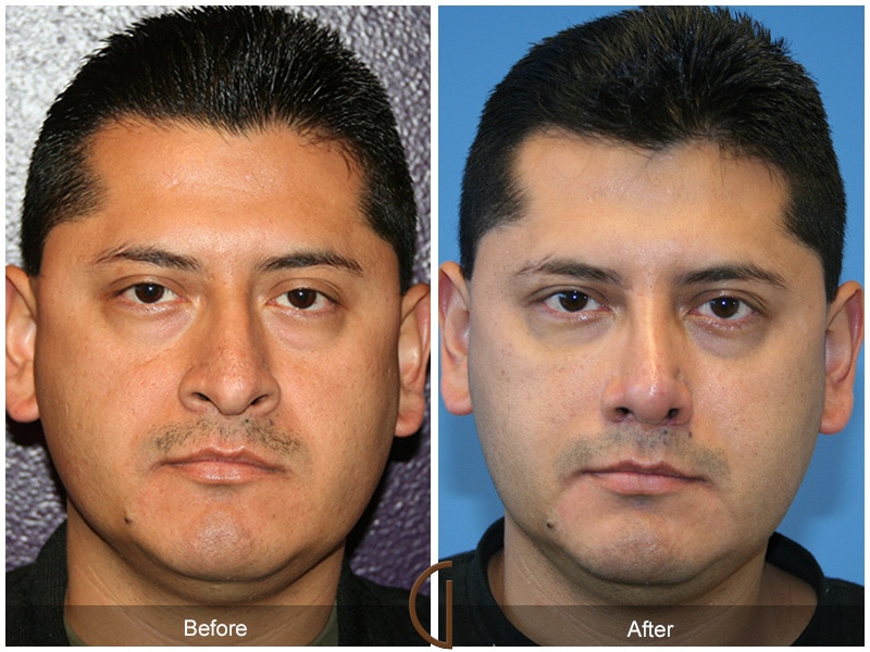 Rhinoplasty Costs Long Beach California