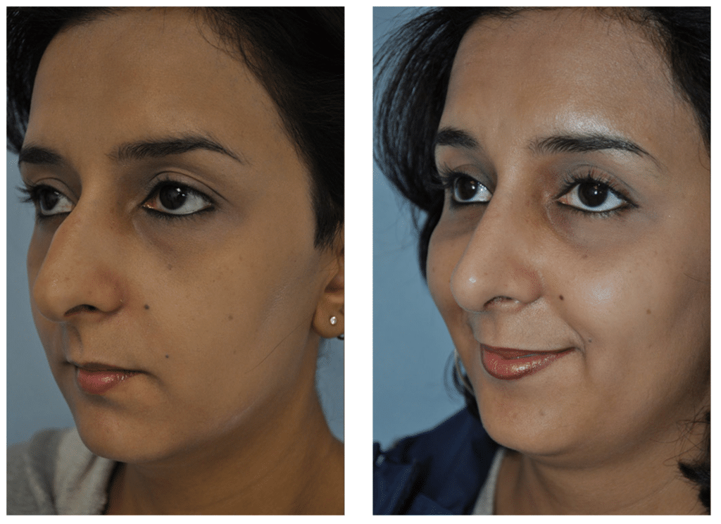 Rhinoplasty Costs Los Angeles California