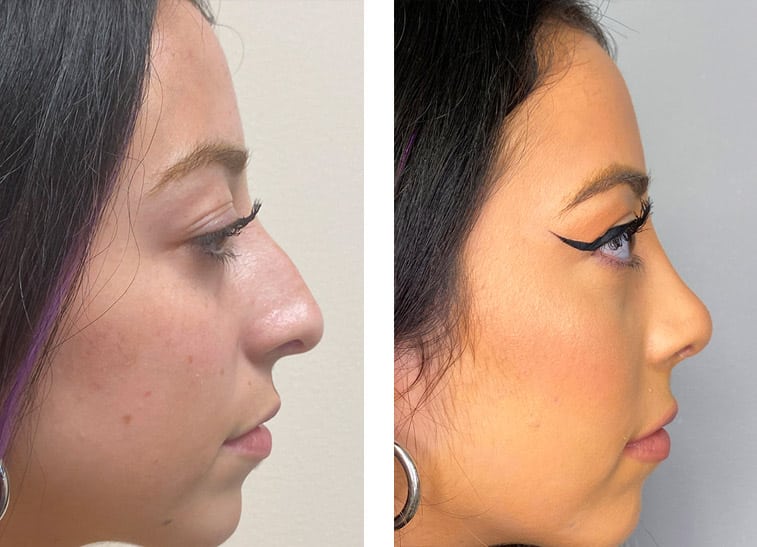 Rhinoplasty Costs Los Angeles California