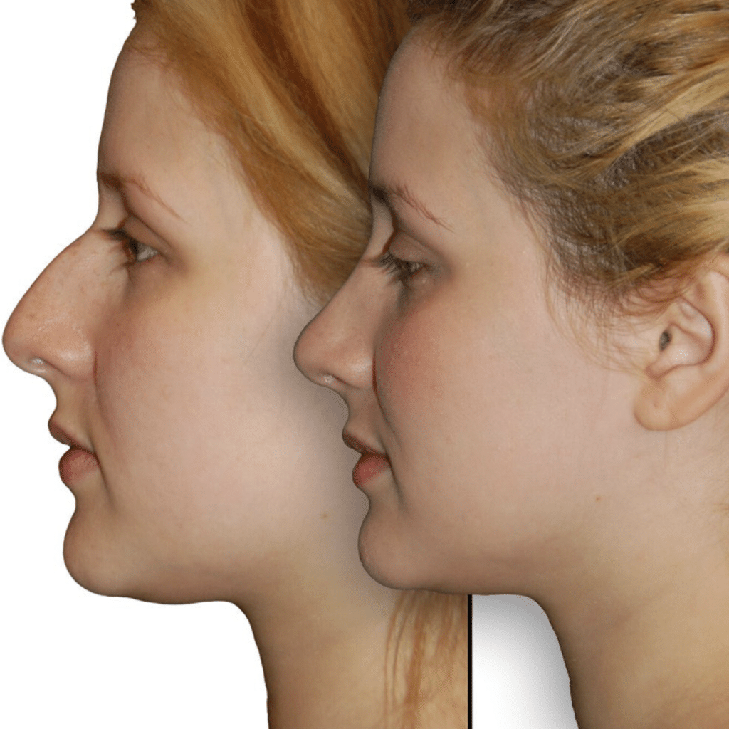 Rhinoplasty Costs Los Angeles California