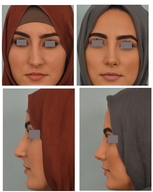 Rhinoplasty Costs Los Angeles California