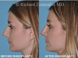 Rhinoplasty Costs Los Angeles California