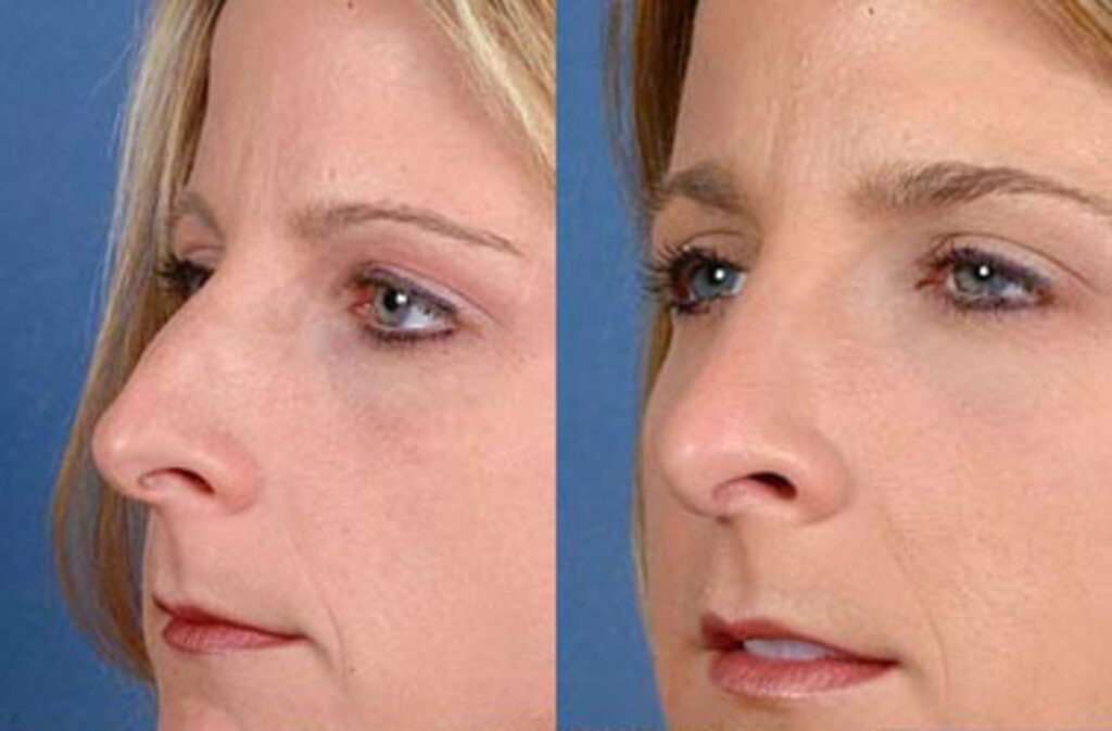 Rhinoplasty Costs Louisville Jefferson County Kentucky