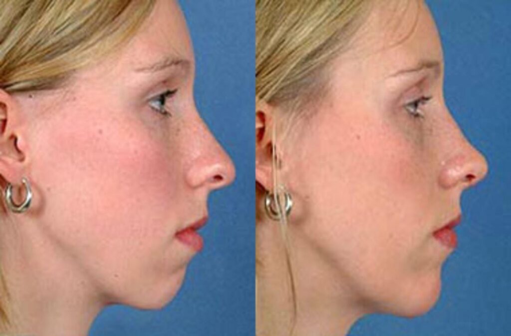 Rhinoplasty Costs Louisville Jefferson County Kentucky
