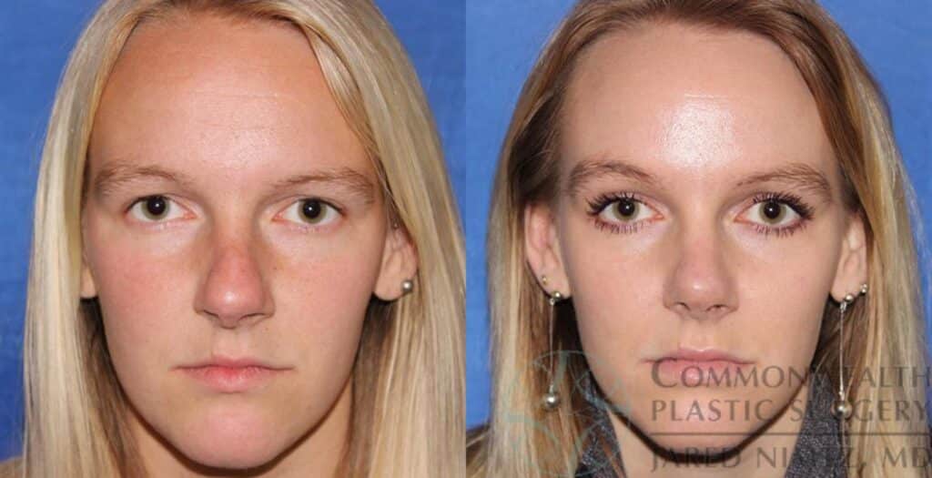 Rhinoplasty Costs Louisville Jefferson County Kentucky