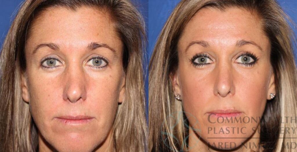 Rhinoplasty Costs Louisville Jefferson County Kentucky