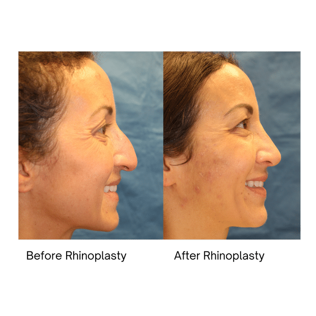 Rhinoplasty Costs Louisville Jefferson County Kentucky