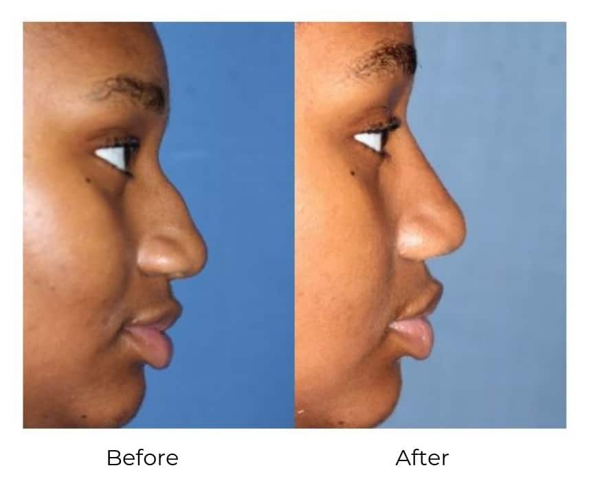 Rhinoplasty Costs Memphis Tennessee