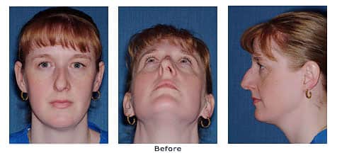 Rhinoplasty Costs Memphis Tennessee