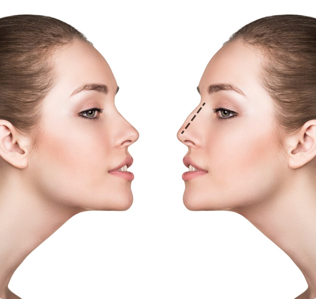 Rhinoplasty Costs Memphis Tennessee