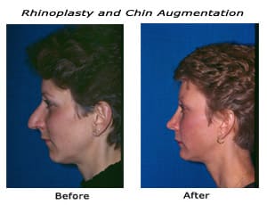 Rhinoplasty Costs Memphis Tennessee