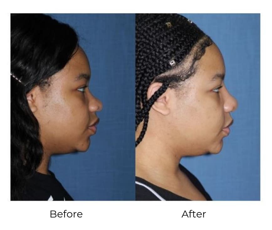 Rhinoplasty Costs Memphis Tennessee