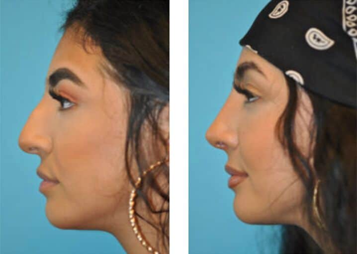Rhinoplasty Costs Mesa Arizona