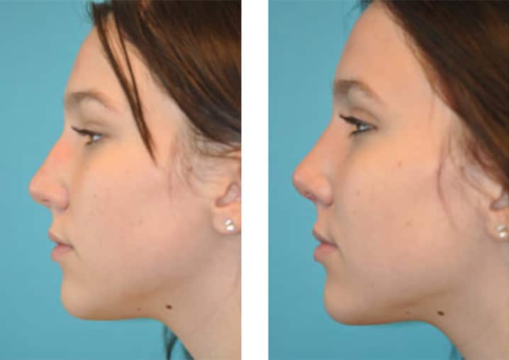 Rhinoplasty Costs Mesa Arizona