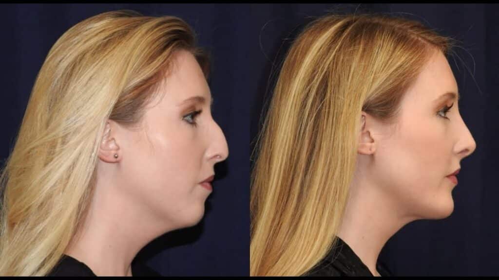 Rhinoplasty Costs Nashville Davidson Tennessee