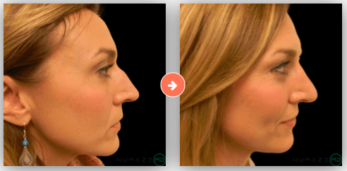 rhinoplasty costs nashville davidson tennessee 2