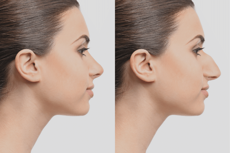 Rhinoplasty Costs Nashville Davidson Tennessee