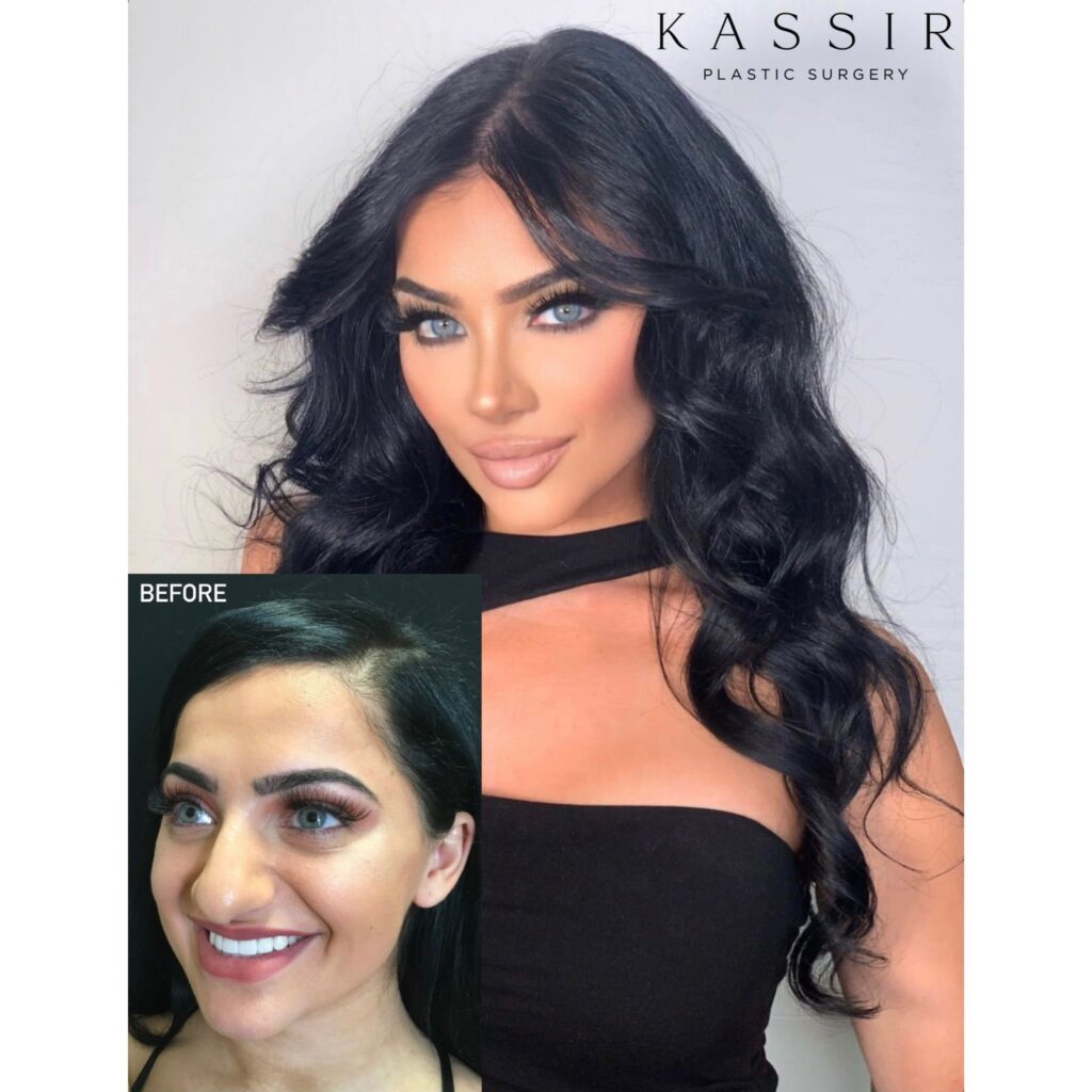 Rhinoplasty Costs New York New York