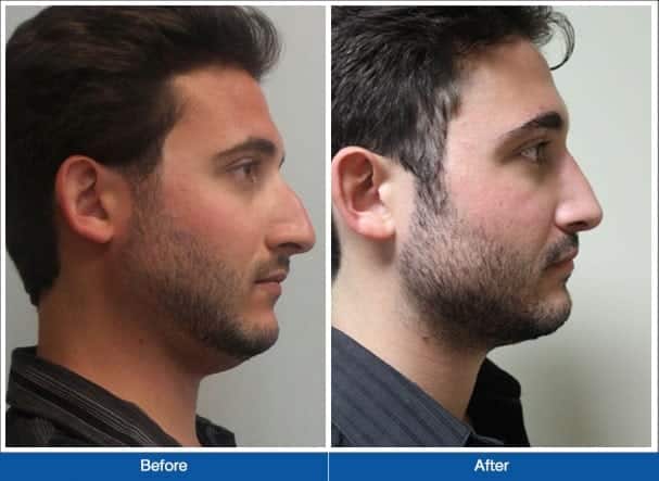 Rhinoplasty Costs New York New York