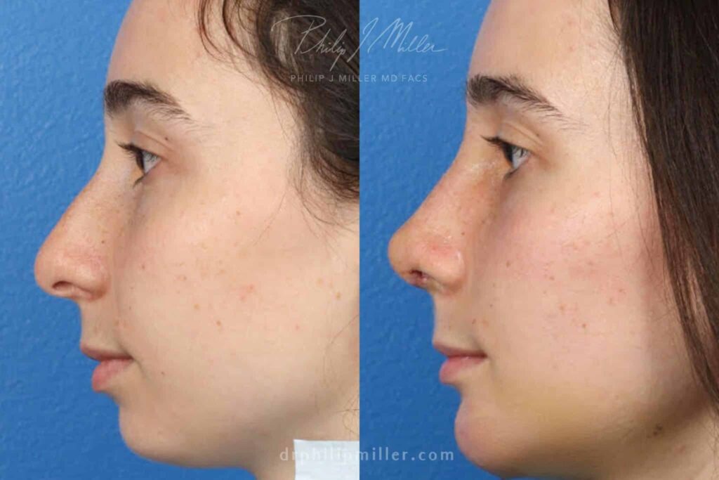 Rhinoplasty Costs New York New York