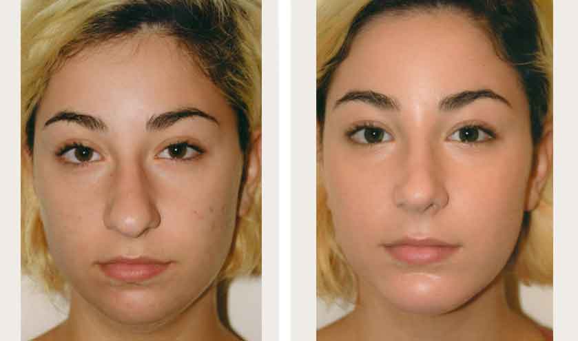 Rhinoplasty Costs New York New York
