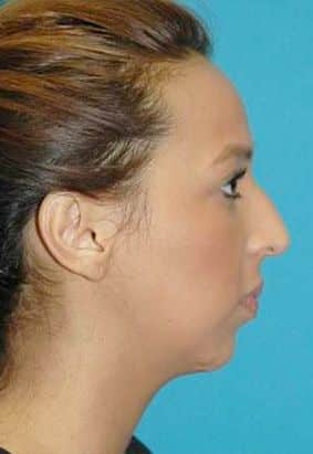 Rhinoplasty Costs Oklahoma City Oklahoma
