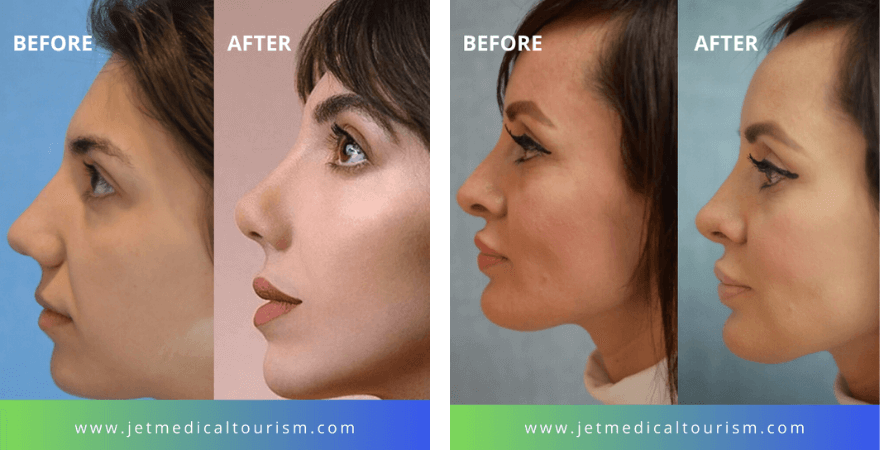 Rhinoplasty Costs Oklahoma City Oklahoma
