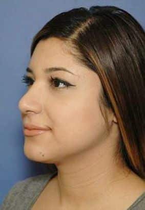 rhinoplasty costs oklahoma city oklahoma 2