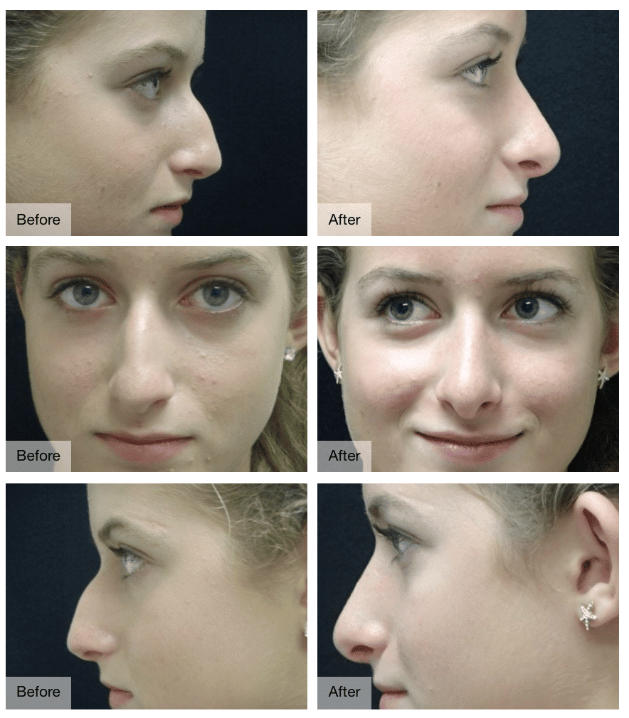 Rhinoplasty Costs Oklahoma City Oklahoma