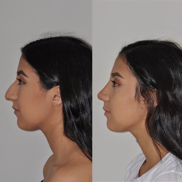 Rhinoplasty Costs Philadelphia Pennsylvania