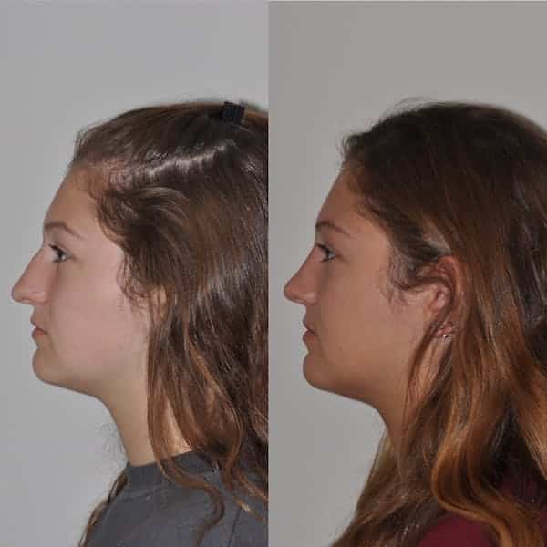 Rhinoplasty Costs Philadelphia Pennsylvania