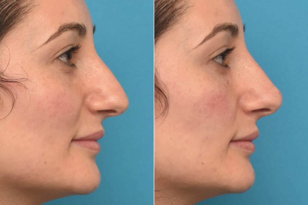 Rhinoplasty Costs Philadelphia Pennsylvania