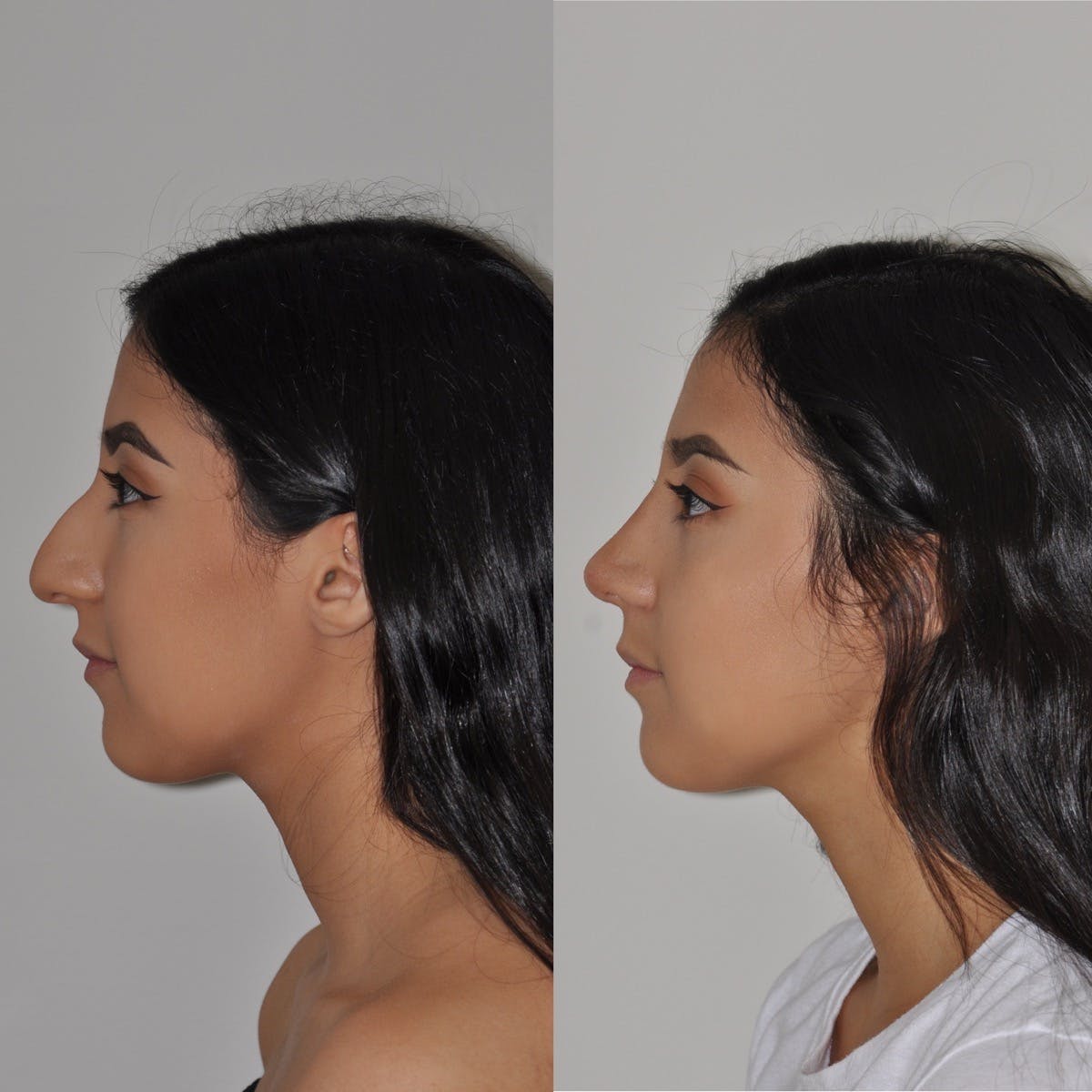 rhinoplasty costs philadelphia pennsylvania 4
