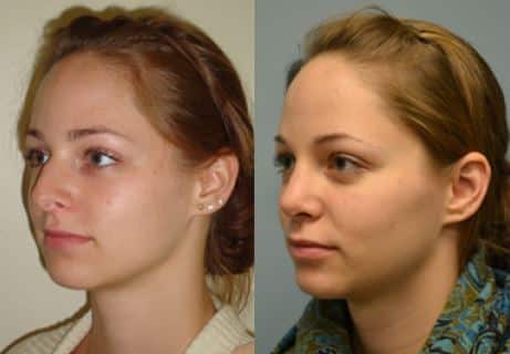 Rhinoplasty Costs Philadelphia Pennsylvania