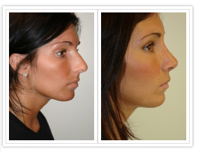 Rhinoplasty Costs Philadelphia Pennsylvania