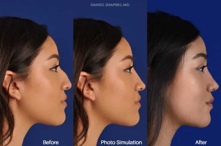 Rhinoplasty Costs Phoenix Arizona