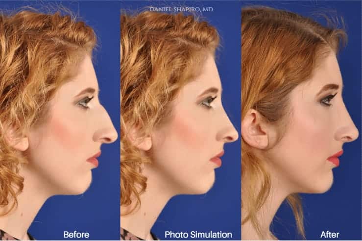 Rhinoplasty Costs Phoenix Arizona